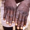 Gambia declares mpox outbreak